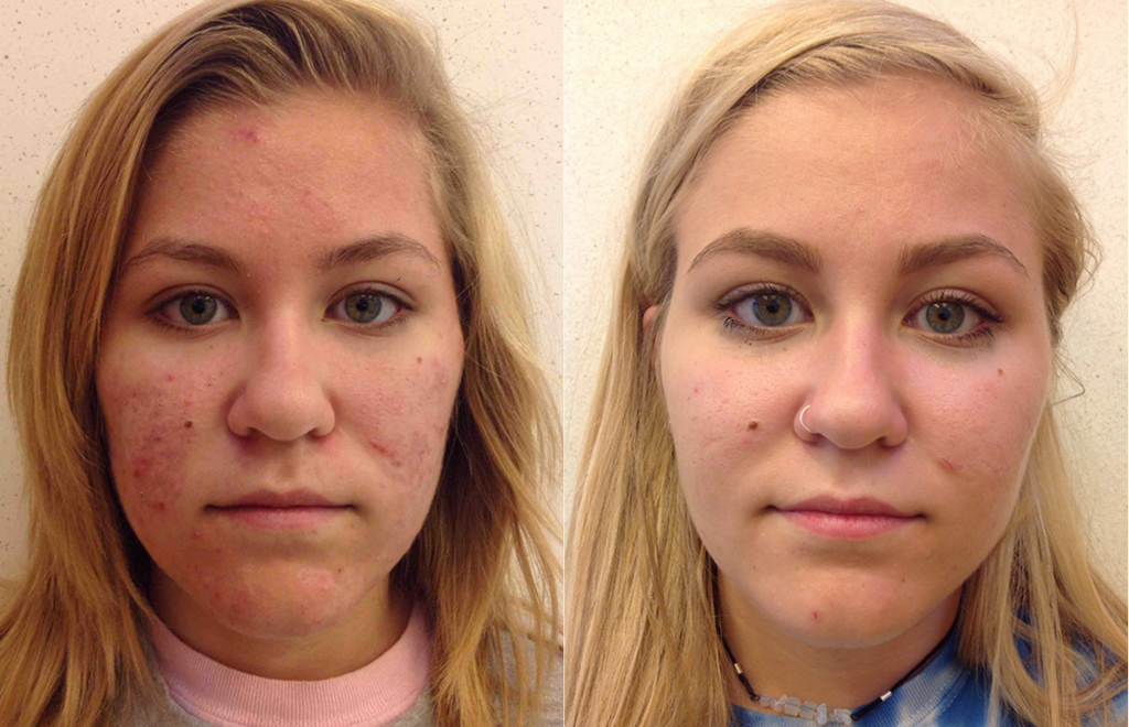 Before and after of a 17-year-old female who was treated with Antibiotics and the LovelySkin LUXE Acne Care System to improve the appearance of acne and overall skin texture.