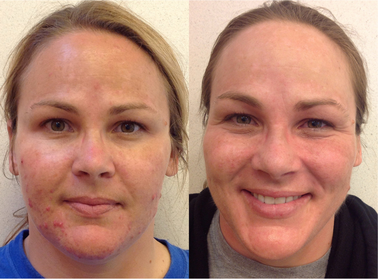 Front-facing picture of a 36 year old female patient before and after acne treatment