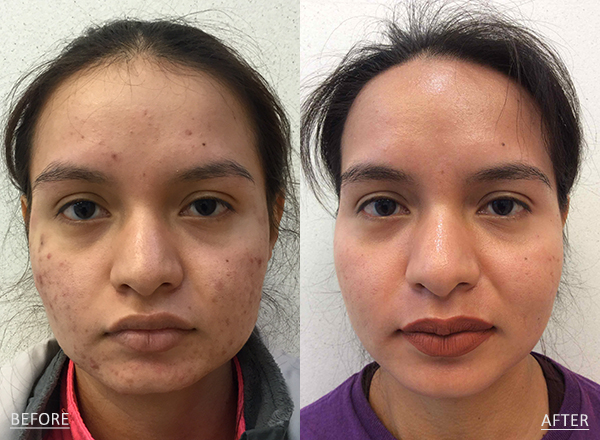 Side by side photos of a dark skin toned 26 year old female before and after acne treatment with Antibiotics and IPL Laser