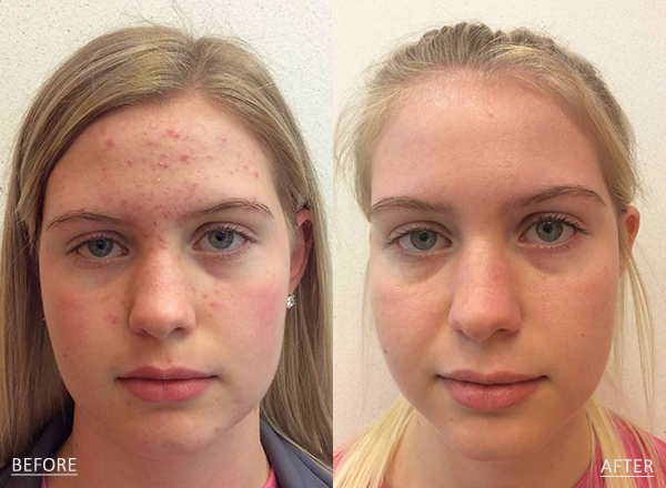 Side by side photos of a light skin toned 15 year old female before and after acne treatment with Antibiotics and the LovelySkin LUXE Acne Care System.