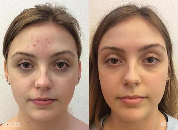 Side by side photos of a light skin toned 17 year old female before and after acne treatment with Antibiotics and the LovelySkin LUXE Acne Care System.