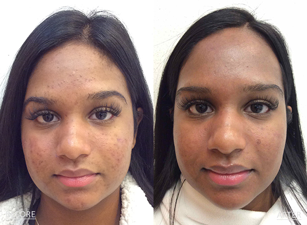 Side by side photos of a dark skin toned 22 year old female before and after acne treatment with Antibiotics and the LovelySkin LUXE Acne Care System.