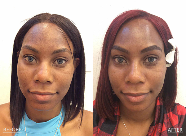 Side by side photos of a dark skin toned 31 year old female before and after acne treatment with Accutane and Antibiotics.