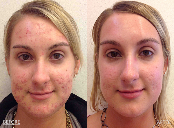 A 27-year-old female who was treated with Accutane to improve the appearance of acne and overall skin texture.