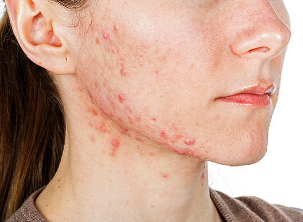 Close up of light skin toned female with acne along face and neck