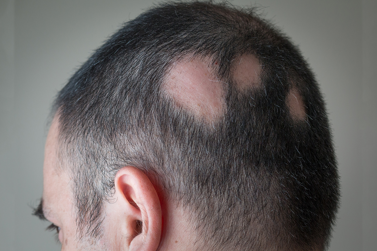 Man with alopecia