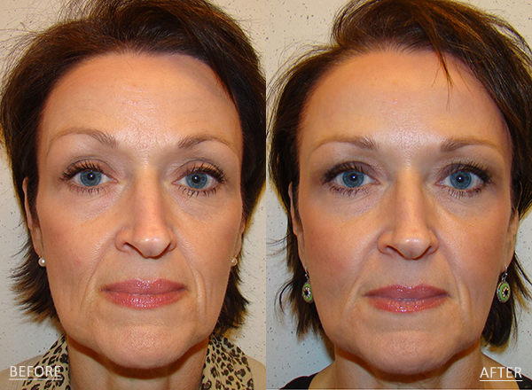 Before and after of a A 54-year-old woman who had Dysport administered to the crow’s feet, forehead and glabellar lines to diminish the appearance of fine lines and wrinkles along with a series of fillers to improve volume loss.