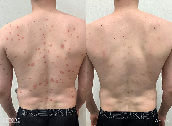 A 25-year-old Male patient treated for Psoriasis located on chest and back, results; Two Months Post Treatment with Biologic Cosentyx.