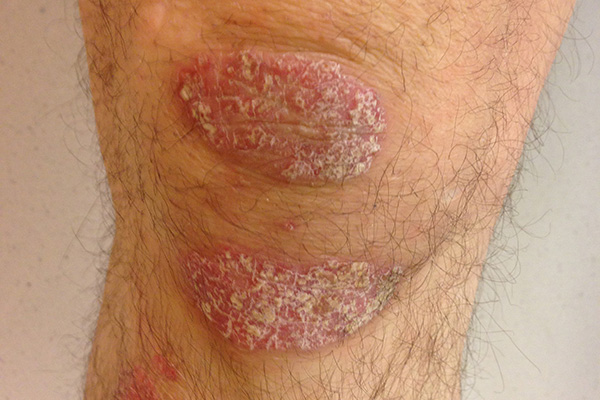 Knee with psoriasis 