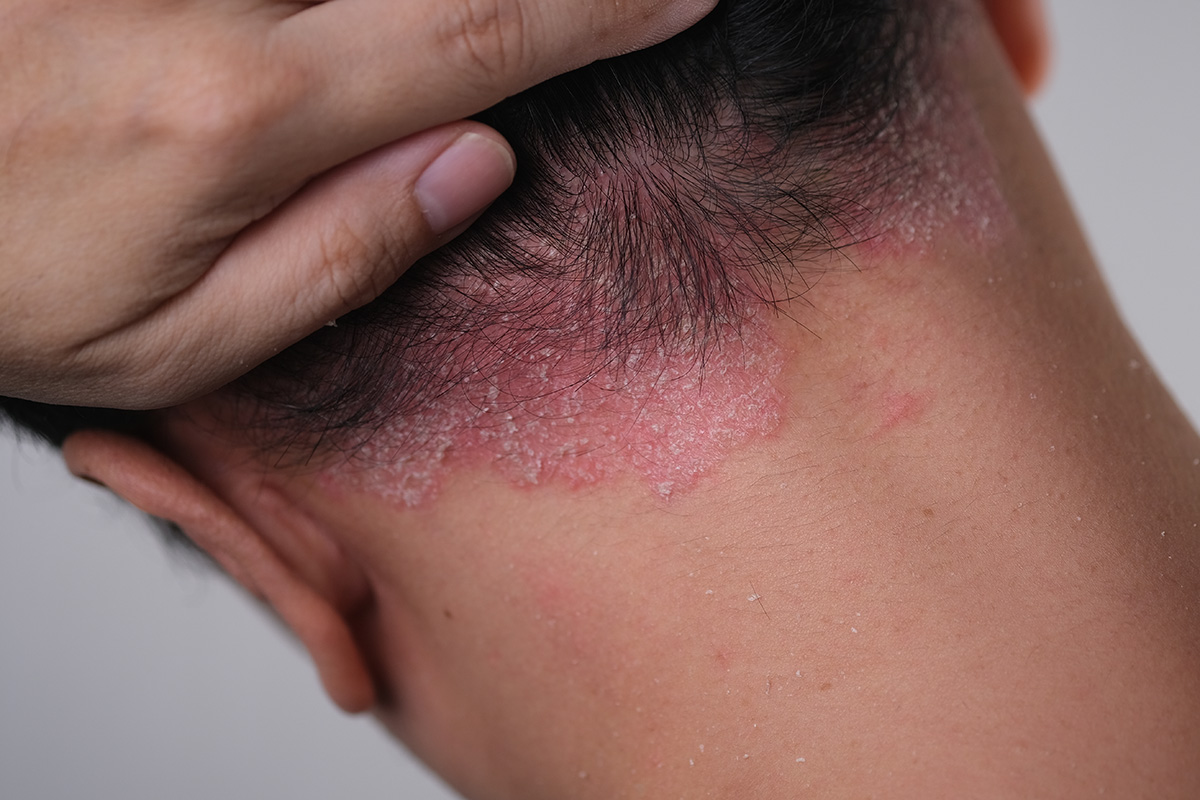 Back of man's scalp with psoriasis