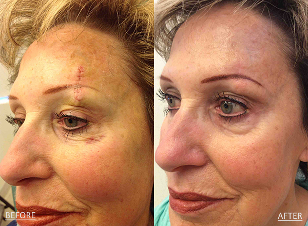 Before and after of a light skin toned Female A 71-year-old Female patient treated with MOH’s Surgery for Skin Cancer removal located on the left eyebrow.