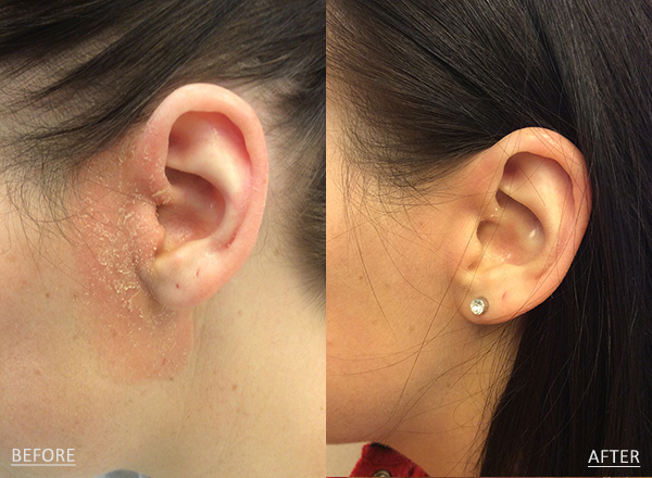 Before and after of a light skin toned Female treated for Seborrheic Dermatitis located on the ear