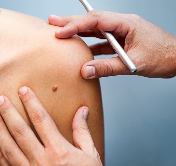 Doctor checking a suspicious mole for signs of skin cancer