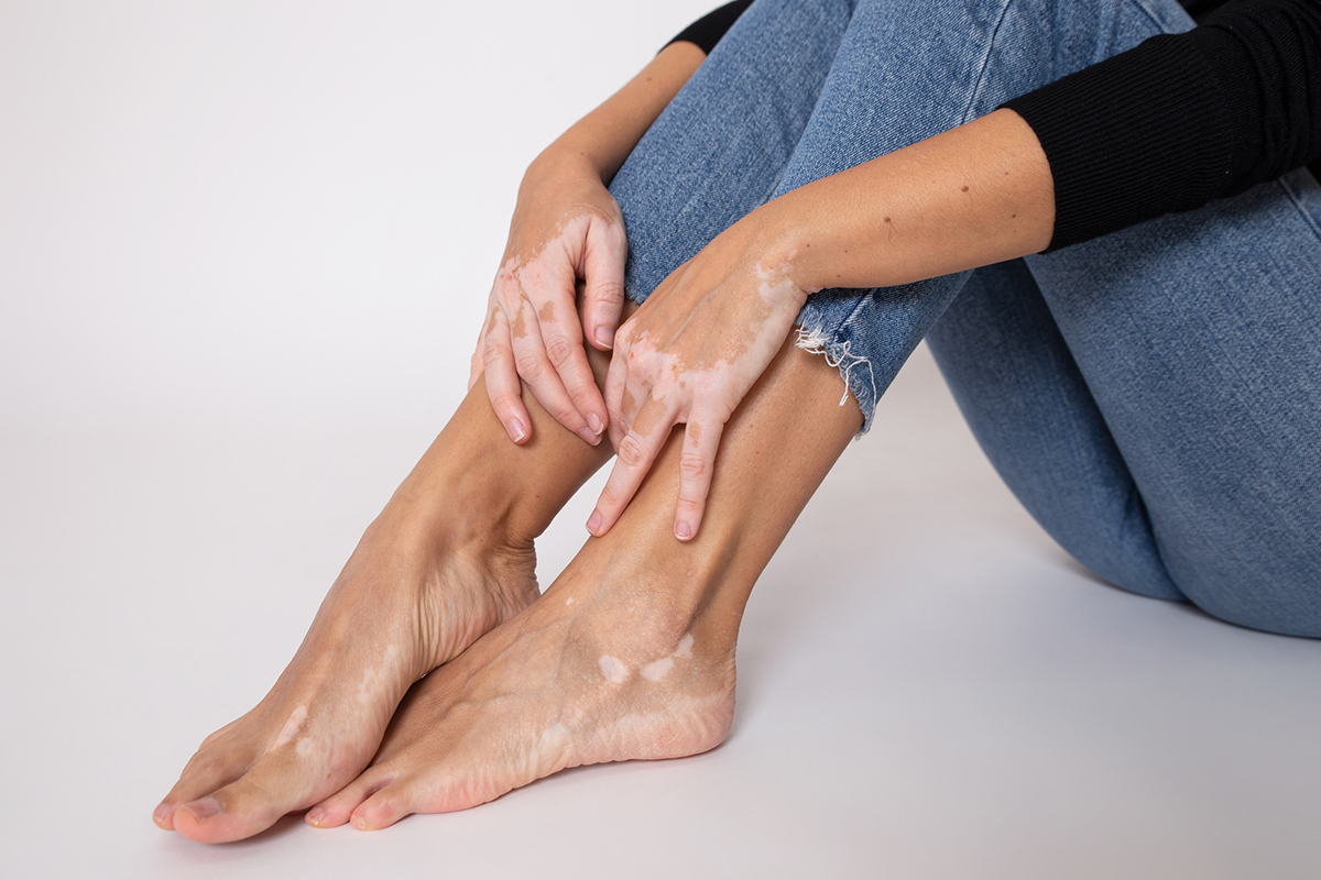 Women's legs and hands with vitiligo