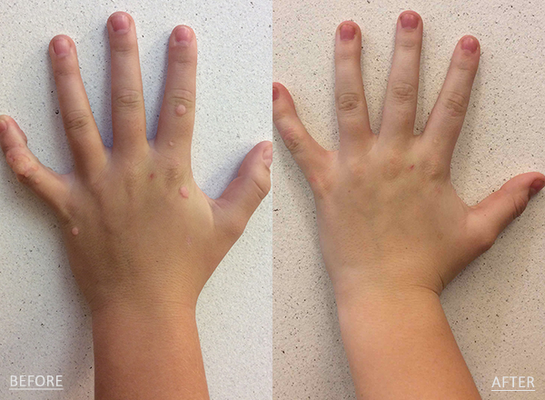 Before and after of a light skin toned Male patient treated for Wart Removal with DNCB Treatment located on hand.