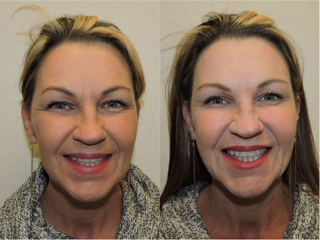 Before and after of a 48-year-old Female who had Botox along with a combination of Restylane and Juvederm Fillers to diminish the appearance of fine lines and wrinkles and improve volume loss.