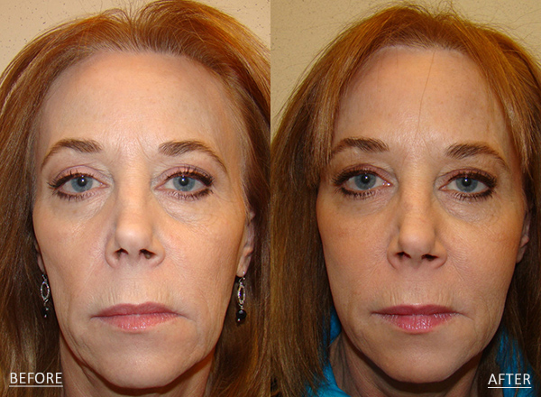 Before and after a 60-year-old female who was treated with Botox administered to the crow’s feet, forehead and glabellar lines to diminish the appearance of fine lines and wrinkles along with a series of fillers to improve volume loss.