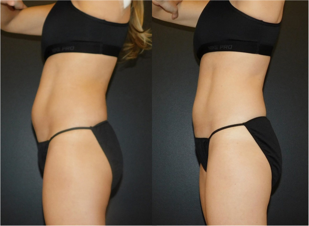 Before and after of a female patient who was treated with CoolSculpting to the lower Abdomen to improve the appearance of visible unwanted fat.