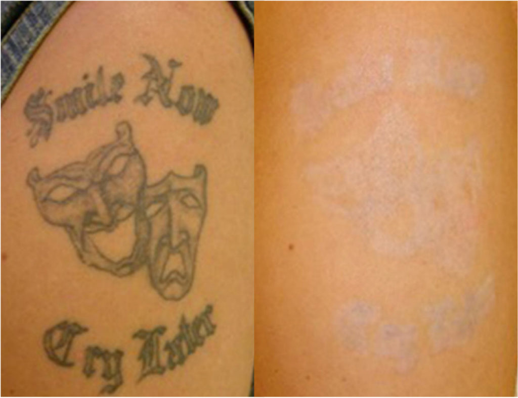 Before and after of a male patient treated with Laser Tattoo Removal to reduce the appearance of unwanted body art on arm.