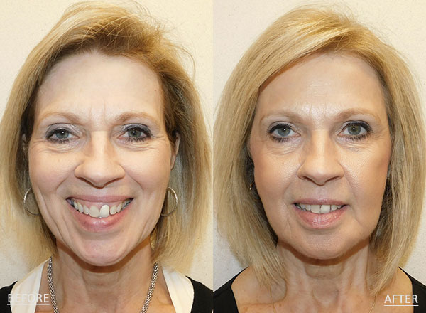 Before and after of a 63-year-old woman who had Botox administered to the crow’s feet, forehead and glabellar lines to diminish the appearance of fine lines and wrinkles along with a series of fillers to improve volume loss.