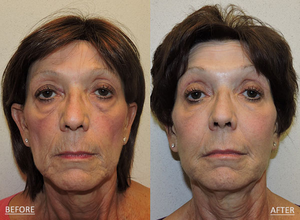 Before and after of a 60-year-old female who was treated with Botox administered to the crow’s feet, forehead and glabellar lines to diminish the appearance of fine lines and wrinkles along with a series of fillers to improve volume loss.