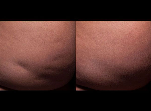 Before and after of a female patient treated with Cellfina to the buttocks area to improve the appearance of visible unwanted cellulite; results 3 months post one treatment.