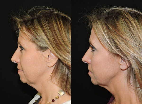 Before and after of a 46-year-old Female patient treated with the Kybella Injectable treatment to dissolve fat in the lower jawline in order to minimize and improve the appearance of a double chin.