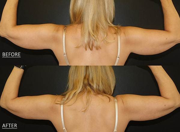 Before and after of a female patient who was treated with CoolSculpting to arms to improve the appearance of visible unwanted fat.