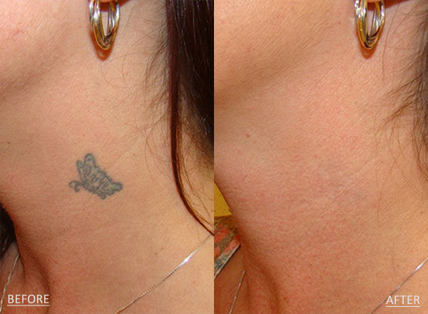 Before and after of a female patient treated with Laser Tattoo Removal to reduce the appearance of unwanted body art on neck.