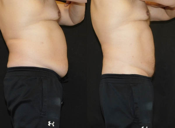 Before and after of a male patient treated with SmartLipo to the Abdomen and Flanks to slim and reduce the appearance of visible unwanted fat.