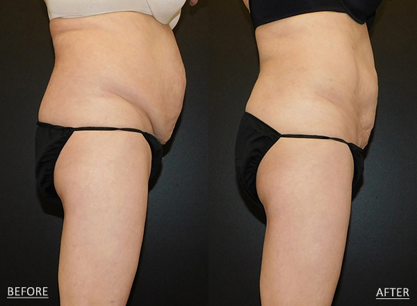 Before and after of a female patient treated with SmartLipo to the Abdomen and Flanks to slim and reduce the appearance of visible unwanted fat.