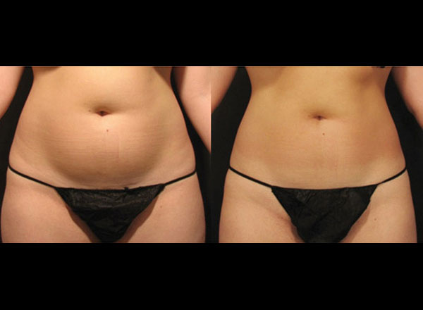 Before and after of a Female patient who was treated with VelaShape to the abdomen to slim and smooth the appearance of Cellulite.