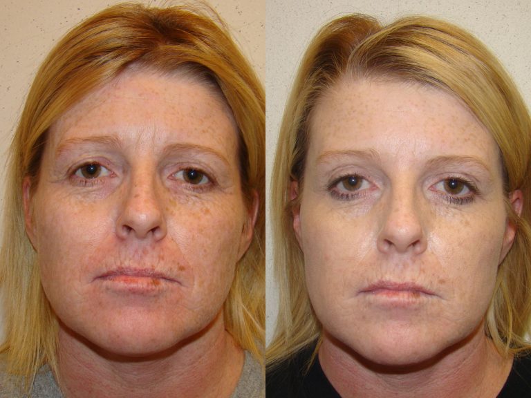 Before and after of a 44-year-old Female patient treated with AquaGold and a series of dermal fillers