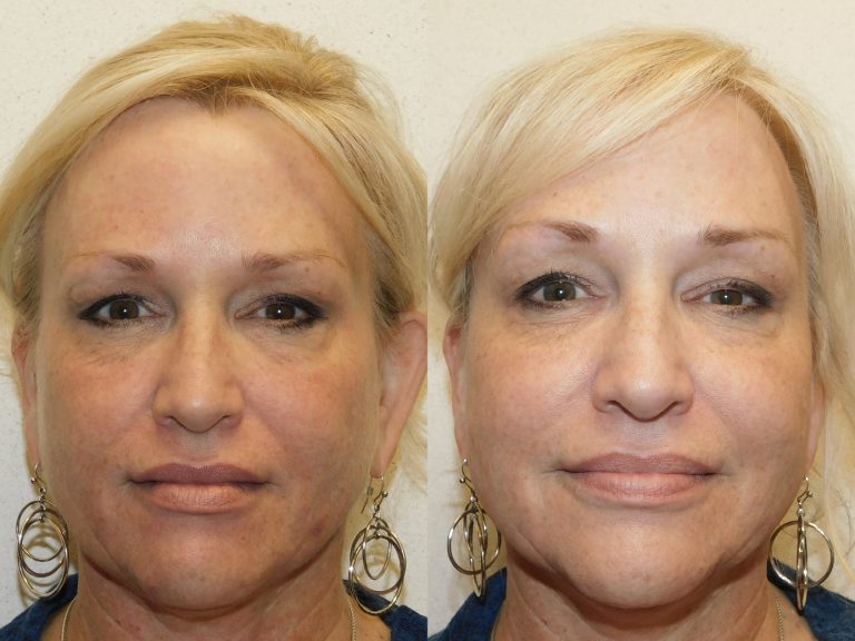 Before and after of a 55-year-old Female patient treated with EndyMed Microneedling