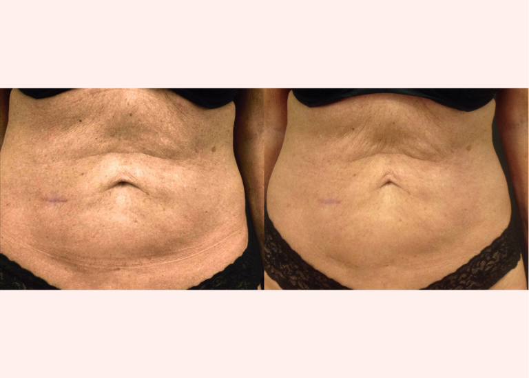 Before and after of a Female patient who was treated in LovelySkin Spa with PelleFirm to the abdomen