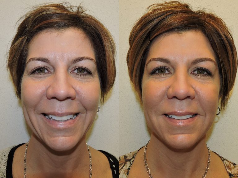 Before and after of a  50-year-old Female treated with a combination of Restylane Fillers