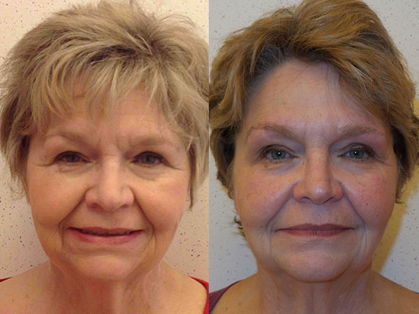 Before and after of a 65-year-old Female patient treated with Botox along with a series of fillers and Full Face Ultherapy 