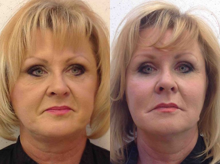 Before and after of a 55-year-old Female patient treated with Botox along with a series of fillers