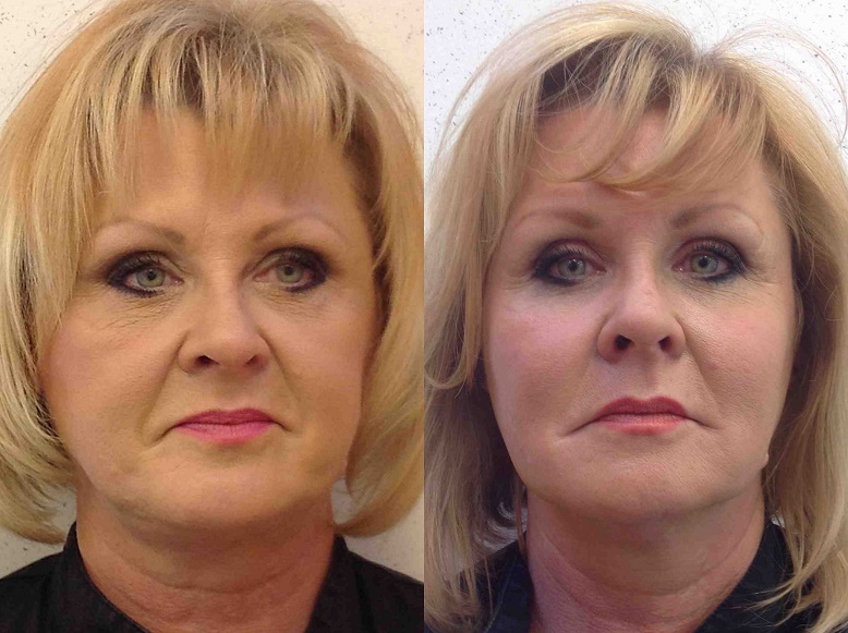 Xeomin & Fillers Before and After