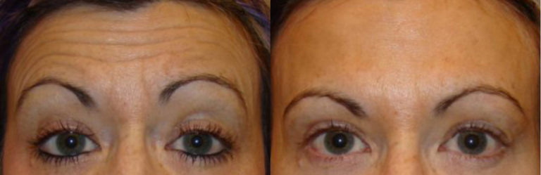 Before and after of a A 48-year-old female who was treated with Botox along with a series of fillers.