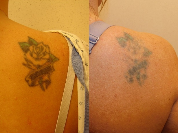 Before and after of a Female patient treated with Laser Tattoo Removal on shoulder blade.