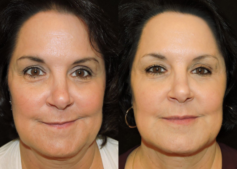 Before and after of a 60-year-old Female patient treated with Juvederm Volbella Filler