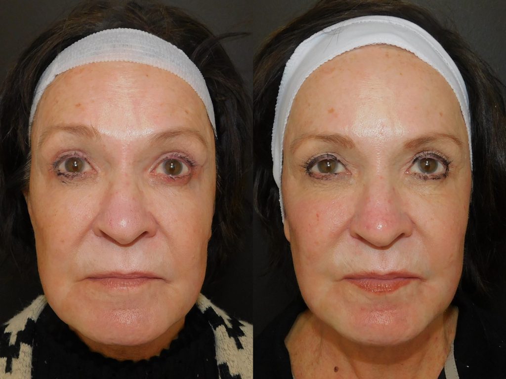 Before and after of woman who received Halo treatment front on (10 days post procedure)