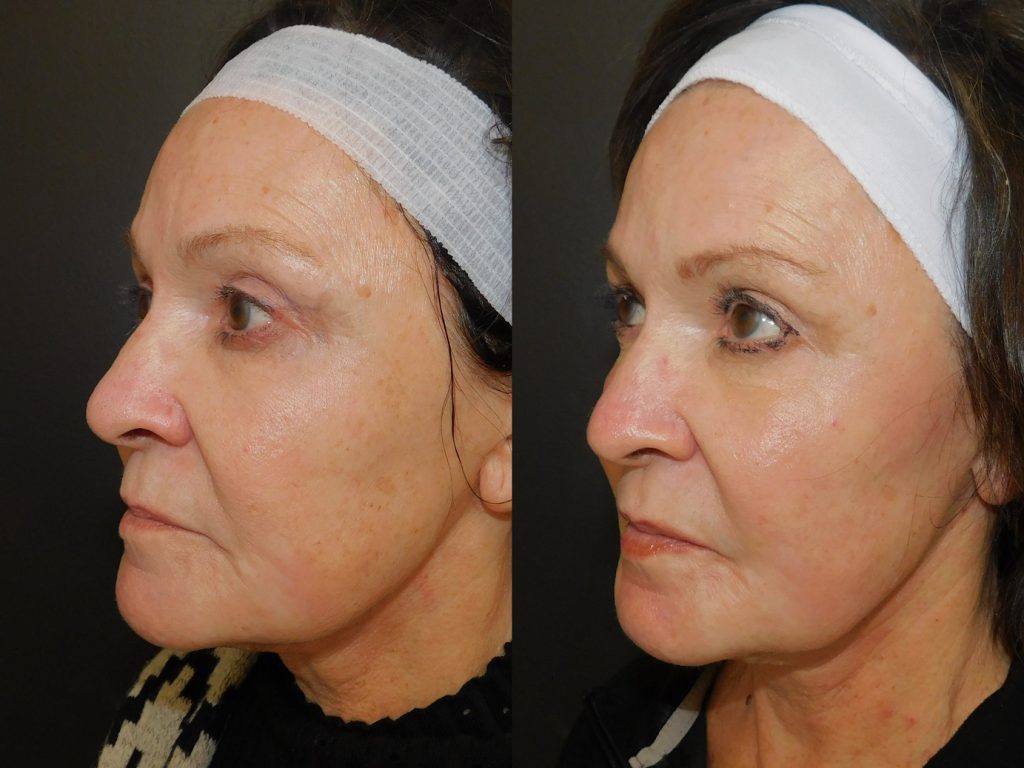 Before and after of woman who received Halo treatment left side of face (10 days post procedure)