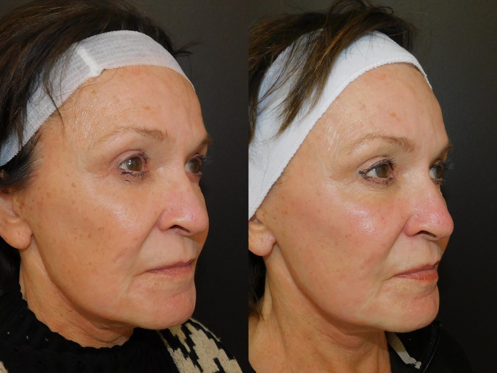 Before and after of woman who received Halo treatment right side of face (10 days post procedure)