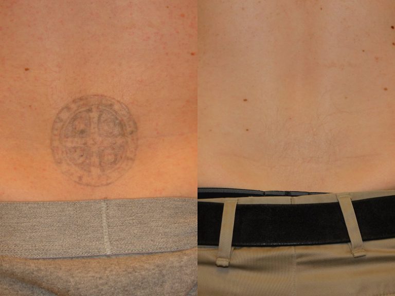 Before and after of a Male patient treated with Laser Tattoo Removal on lower back.