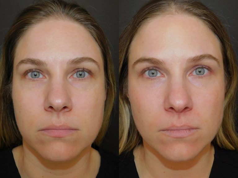 Before and after of a woman treated with MOXI 11 days post procedure