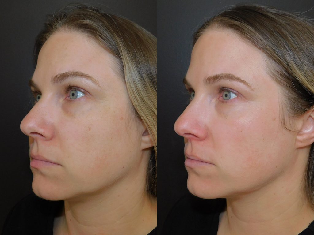 Before and after of woman who received Moxi treatment left side of face (11 days post procedure)