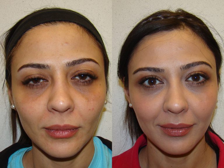 Before and after of a 36-year-old Female patient treated with Restylane Filler