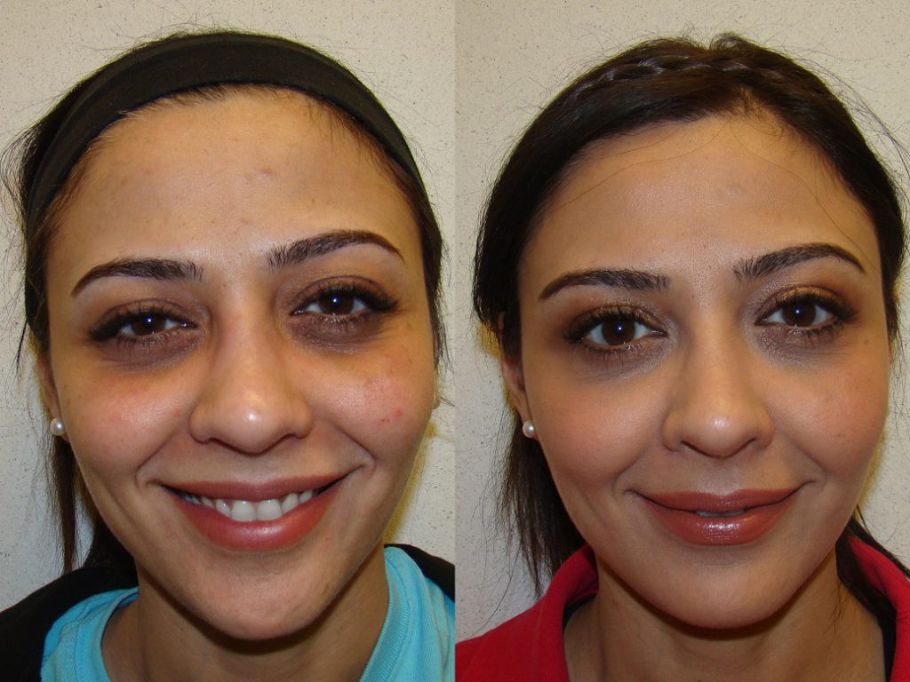 Restylane Filler Under Eyes Before and After